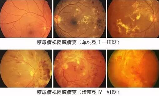 糖尿病引起的眼部并发症有很多，糖尿病视网膜病变(DR)就是其中之一，糖尿病视网膜病变是糖尿病在眼部的一种严重并发症，它对视力有很大危害，如不及时医治，可能造成失明。症状包括视力模糊、阴影、斑点及疼痛。.jpg