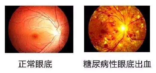  数据表明：糖尿病视网膜病变(简称糖网病)患病率达44%~51.3%，被世界卫生组织认为是仅次于白内障、青光眼的 三致盲眼病。但是不少尤其是基层糖尿病患者，大多数把眼睛的异变误认为是老年人眼花正常现象，从而耽误了病情甚至导致失明。.jpg
