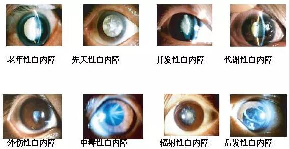 长时间在白色光亮污染环境下工作和生活的人，尤其是长时间接触过强的光线，视网膜和虹膜都会受到程度不同的损害，较终也会伤害晶状体，时间一长，就会使视力下降，使晶状体蛋白发生变性，形成混浊，发展成为白内障1.jpg