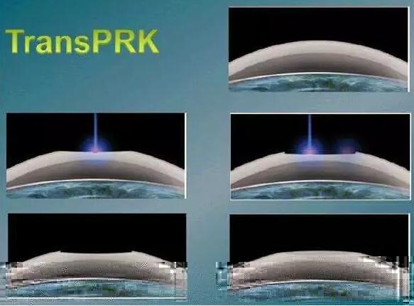 全激光TransPRK手术有其无可比拟的优势，但是 一的缺点就是属于表层手术，术后三天需要配戴隐形眼镜等待上皮愈合，在术后当天以及术后早期眼部会有较飞秒较重的不适感， 时间稍慢，一般需要一周到十天才能逐渐 .jpg