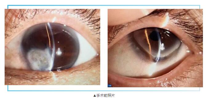 即便天气如此恶劣，合肥名人眼科医院的所有医护人员依然兢兢业业的守护在自己的岗位上。其中有两位患者分别来自安徽的蒙城和涡阳，一 角膜愈着性白斑，致虹膜前后黏连，视力仅有手动。另一 角膜严重边缘变性致穿孔，急需通过角膜移植手术保住眼球。2.jpg