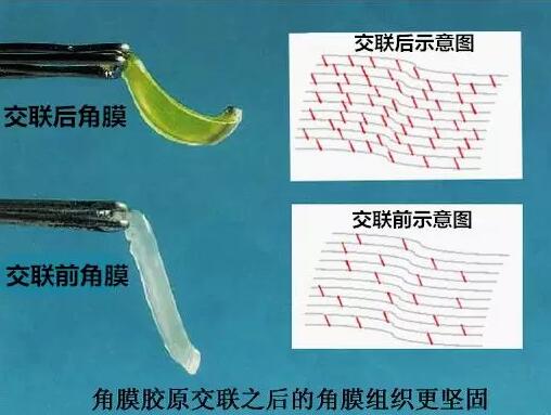 角膜胶原交联(Corneal Cross Linking，CCL)医治：使用370纳米波长的紫外线，激活核黄素(一种光敏感剂)，使其转化成活性氧族，活性氧族再诱导角膜胶原纤维的氨基之间发生化学交联反应，使角膜胶原纤维直径增粗、提*角膜基质对多种降解酶作用的抵抗力等多重生物学效应，从而使角膜基质的机械强度增加2.jpg