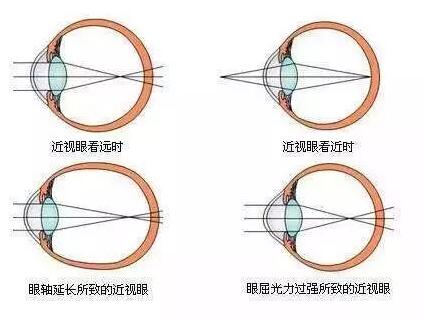 “小孩视力以前挺好的，没想到一个寒假下来就近视了。”昨天的华厦眼科医院小儿眼科门诊里，很多家长都反应说，“孩子期末成绩不错，所以假期里对他的管束放松了，一有空就拿起手机玩。直到前几天，他嚷着看东西变模糊了，才带孩子来医院检查，检查结果是左右眼出现不同程度的近视，医生建议配戴眼镜。.jpg