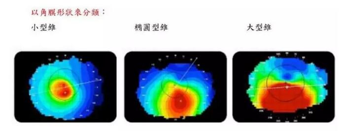 圆锥角膜是一种角膜扩张性疾病，患病后角膜中央或偏中央区域会发生局部变薄向外扩张，导致散光，并随着病情进展逐渐出现视力下降、 不良、视物扭曲变形、虹视等，极大影响生活，严重者可致盲。2.jpg
