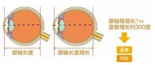 目前主流的摘镜方式有飞秒激光、准分子激光手术、ICL晶体植入术等近视手术方式，不论是高度近视、超高度近视、角膜偏薄患者、干眼患者， 检查合格，都有相应的近视手术 方案。.jpg