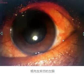 白内障和青光眼都是致盲性眼病，其中青光眼的病程不逆转。杨先生拖延伤情导致同时并发白内障、青光眼的情况，十分令人惋惜。”出名眼科专家、成都华厦眼科医院陈晓明教授表示2.jpg