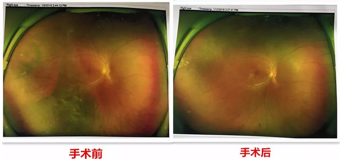 去年小李怀孕时，视力明显下降，甚至影响到了正常生活，这时已从怀孕初期的喜悦中冷静下来的小李，找到了福州眼科医院进行了一*次眼部检查。2.png