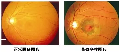 黄斑位于人眼底视网膜的中央，是视力 敏锐的部位，一般医生在测视力时，就是在检查黄斑区的视觉能力。当黄斑区出现异常时，也就是黄斑病变，人的中心视力就会变模糊、变扭曲。.png