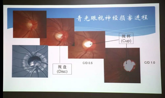 3月10日上午，深圳华厦眼科医院“早查监控，守护光明”大型青光眼公益科普讲座在六楼 举行，本次活动旨在让更多人了解青光眼的潜在危害、重视眼检查， 预防青光眼。由深圳华厦眼科医院青光眼病科 席专家成洪波博士、傅培副院长现场面对面解答疑问，与参会者的互动交流，让更多深圳市民提*对青光眼的认识与防治知识3.png