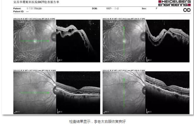 李老太在毫无征兆的情况下右眼视力下降至看不见东西。李老太家人带其至县医院就诊。医生诊断为视网膜脱离，需做玻切手术医治，而玻切手术需要动手术2次。怕疼的李老太一听就犯怵了：开刀，疼。 终，李老太的家人在多方打听后决定带李老太至宜昌华厦眼科医院找许大玲院长医治4.jpg