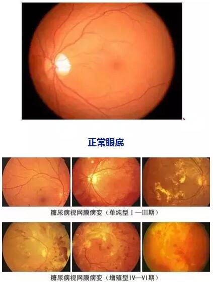 4月14日(本周六)福州眼科医院将举办“常见老年人眼底病”公益讲座，由医院副院长、眼底病科何建忠主任主讲，为大家解读各类眼底疾病的预防和诊治知识1.jpg
