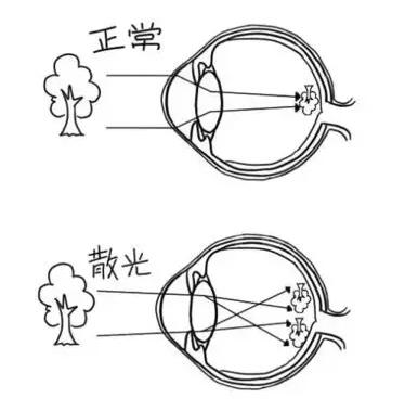 近视加散光想要 ，飞秒全激光近视手术是很好的选择。 一*次近视激光手术，就可以同时 近视、合并散光。1.jpg