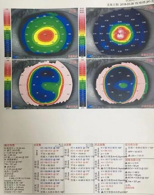 角膜移植是利用异体的正常透明角膜组织，取代浑浊病变的角膜组织，使患者复明或控制角膜病变，这在目前同种器官移植当中， 率是 高的，也是重要的复明手术之一。”在 为一位饱受圆锥角膜之苦患者 实施角膜移植之后，卢敏院长也对患者极为关心的角膜移植相关知识进行介绍。比如哪些患者适合角膜移植手术