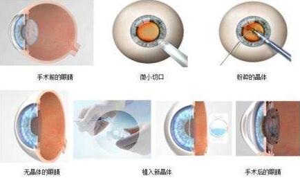三焦点人工晶体手术原理：置换掉人眼老去的晶体，世代的晶体不仅有非常好的弹性，以往传统的白内障手术只是单纯的脱盲复明手术，更多的是解决患者 远视力。而三焦点人工晶体的问世，彻*解决了传统白内障术后仍需配镜的问题，实现了从以往‘看得见’到‘看得清、看得好’的转变.jpg