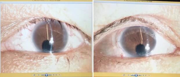 先天性虹膜脉络膜缺损的白内障患者在厦门眼科中心白内障超乳手术后视觉满意2.jpg