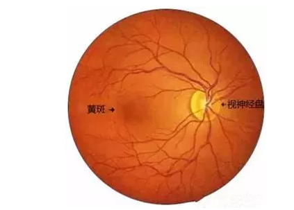 老年黄斑变性其实是眼部黄斑区结构的衰老性改变引起的眼病。“黄斑”是位于视网膜核心区的一个生理结构，一旦黄斑区的视神经细胞被破坏，就会引起患者中心视力下降、视物变形、色暗等1.png