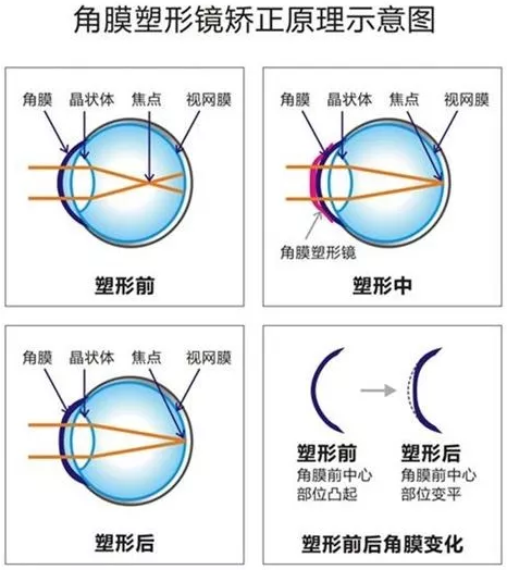 角膜塑形镜是一种硬性透气性隐形眼镜，戴在眼表可使角膜发生塑形效应，从而达到 近视度数的 。适合夜晚睡觉时配戴，白天不用戴眼镜就可以 裸眼视力，不影响学习、运动.png