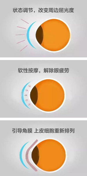 角膜塑形镜是一种硬性透气性隐形眼镜，戴在眼表可使角膜发生塑形效应，从而达到 近视度数的 。适合夜晚睡觉时配戴，白天不用戴眼镜就可以 裸眼视力，不影响学习、运动2.png