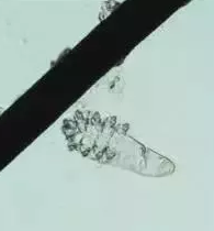 眼部瘙痒、干涩泛红、异物感，可能不是干眼症而是蠕形螨性睑缘炎.png