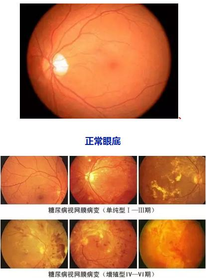 糖网病的症状和防治方式.png
