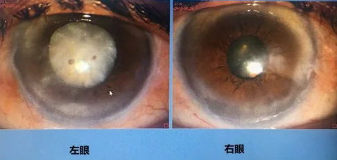 同时患 青光眼、白内障老婆婆辗转几家医院之后终于在成都华厦眼科顺利手术2.png