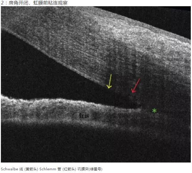 华厦眼科课堂：后节频域OCT前节模块的运用12.jpg