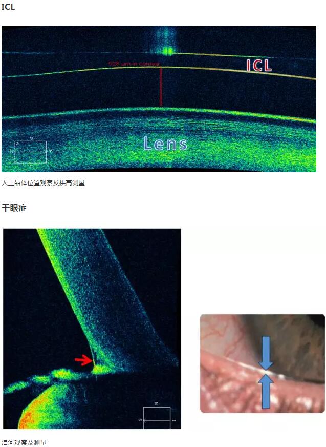 华厦眼科课堂：后节频域OCT前节模块的运用15.jpg