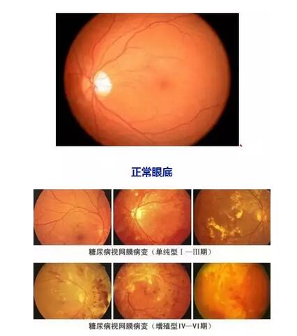 因糖网病几近失明在福州眼科医院进行微创玻切、白内障超乳术后顺利复明2.jpg