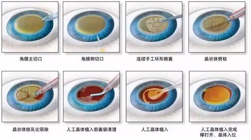 叶院长哪一种白内障手术 ，术后视觉 更好？.jpg