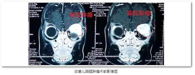 华厦眼科医院斜视与小儿眼科主任苏金萍顺利为新生儿摘除眼眶巨大肿瘤1.png