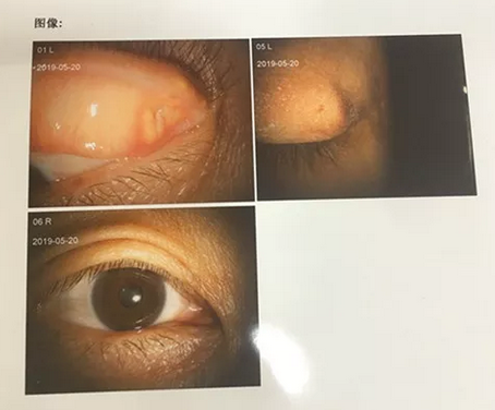 成都华厦眼科罗清礼院长为四处求医未果的河南眼眶肿瘤患者手术2.png