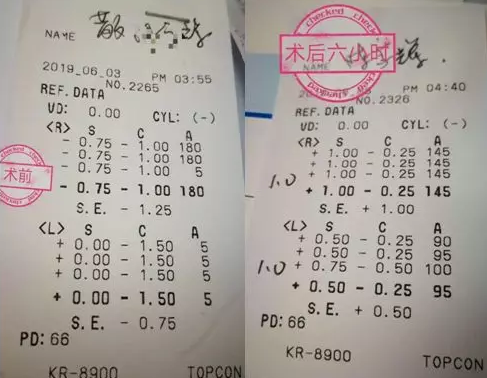 福州眼科医院近视手术取样：视力不差、无法通过参军公考体检群体该怎么办1.png