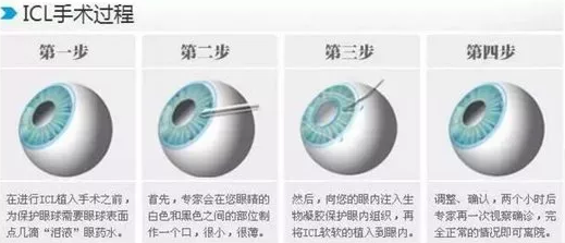 全国高考成绩分数线陆续出来了安徽理工大学附属眼科医院近视手术医生温馨提醒近视考生要注意这些3.png