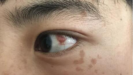 四川丹巴15岁男孩患结膜血管瘤，在成都华厦眼科医院顺利手术1.jpg