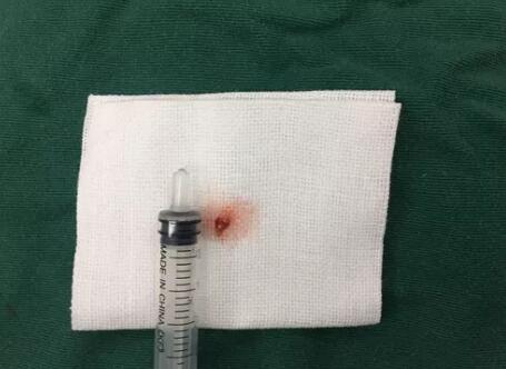 四川丹巴15岁男孩患结膜血管瘤，在成都华厦眼科医院顺利手术3.jpg