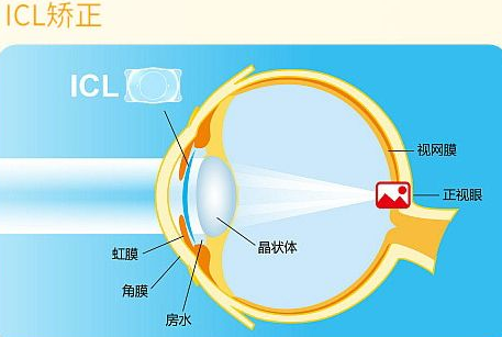 近视无法根治？但你可以这样做？华厦眼科“有爱就有希望”近视手术火热进行中8.png