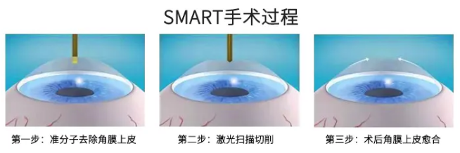高考毕业后做近视手术，如今近视手术有了越来越高的安全性，且多样的术式可以满足不同患者的摘镜需求。2.png