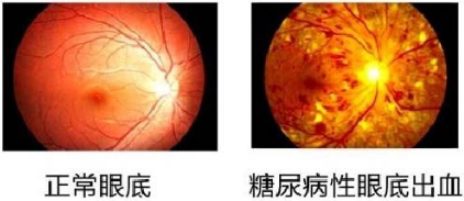 糖尿病为什么会损害眼睛11.28快来听福州眼科医院陈平院长怎么说1.png